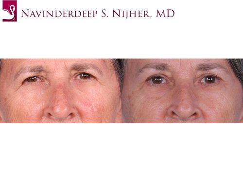 Eyelid Surgery Case #64411 (Image 1)