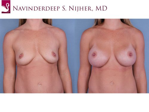 Breast Augmentation Case #65075 (Image 1)