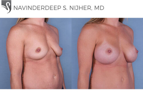 Breast Augmentation Case #65075 (Image 2)