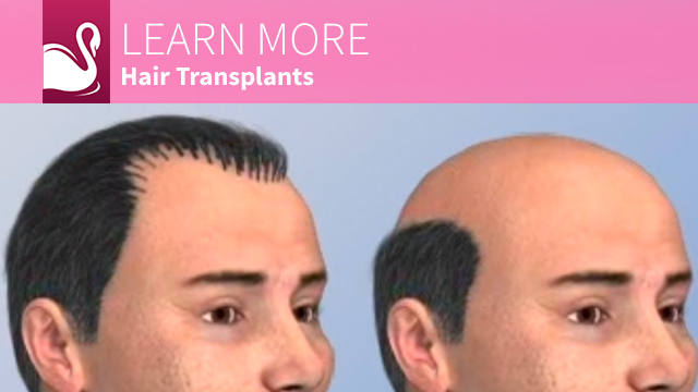 Hair Transplantation - Ocala Plastic Surgery