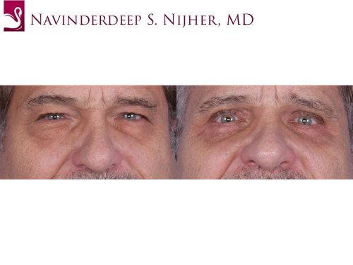Eyelid Surgery Case #64737 (Image 1)