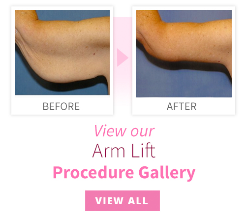 View our Arm Lift Procedure Gallery