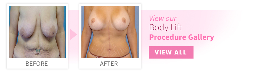 View our Body Lift Procedure Gallery