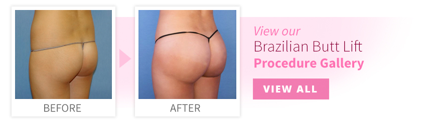 View our Brazilian Butt Lift Procedure Gallery