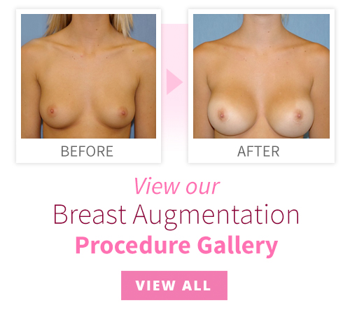 View our Breast Augmentation Procedure Gallery