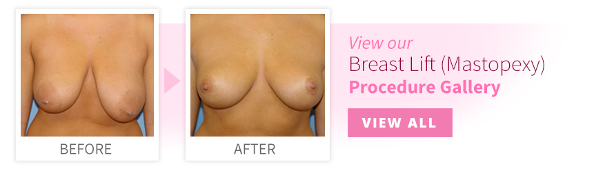 View our Breast Lift Procedure Gallery
