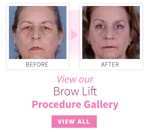 View our Brow Lift Procedure Gallery
