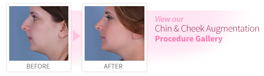 View our Chin and Cheek Augmentation Procedure Gallery