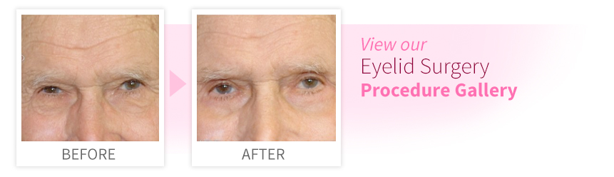 View our Eyelid Surgery Procedure Gallery