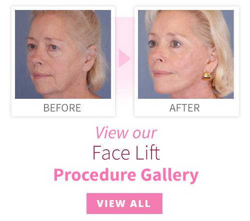 View our Face Lift Procedure Gallery