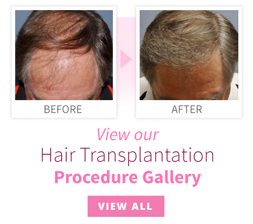 View our Hair Transplantation Procedure Gallery