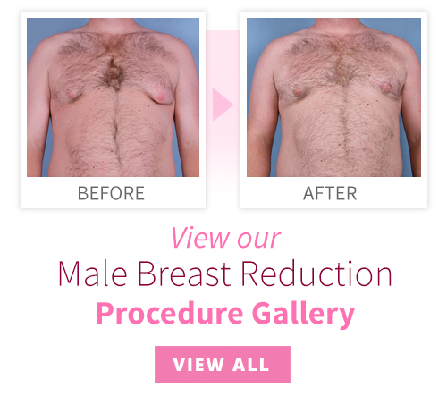 View our Male Breast Reduction Procedure Gallery