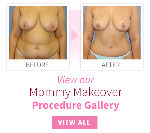 View our Mommy Makeover Procedure Gallery