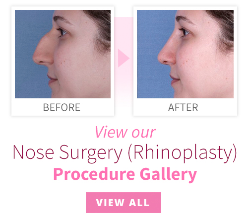 View our Nose Surgery Procedure Gallery