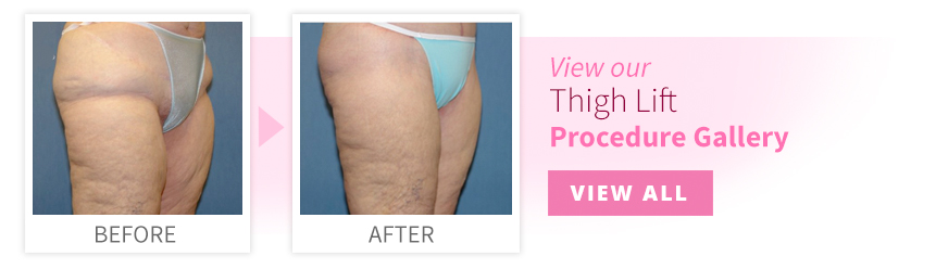 View our Thigh Lift Procedure Gallery