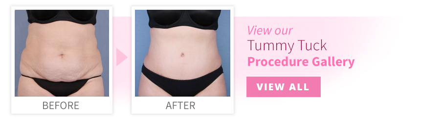 View our Tummy Tuck Procedure Gallery
