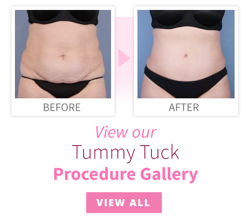 View our Tummy Tuck Procedure Gallery