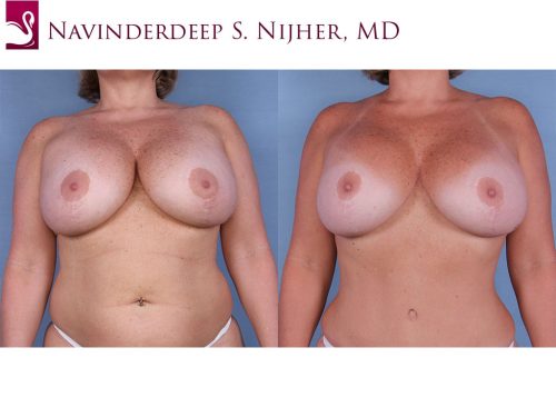 Breast Revisions Case #47923 (Image 1)