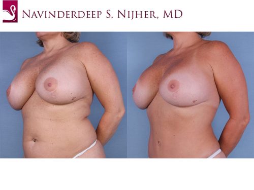 Breast Revisions Case #47923 (Image 2)