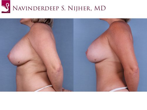 Breast Revisions Case #47923 (Image 3)