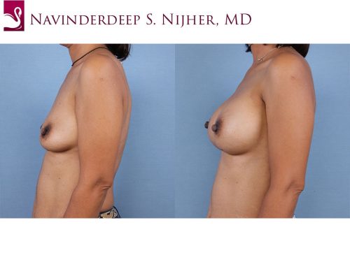 Breast Augmentation Case #64872 (Image 3)