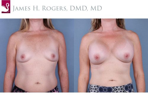 Breast Augmentation Case #65007 (Image 1)