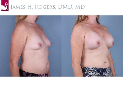 Breast Augmentation Case #65007 (Image 2)