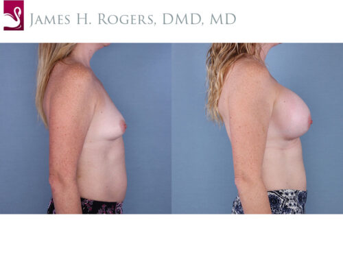 Breast Augmentation Case #65007 (Image 3)