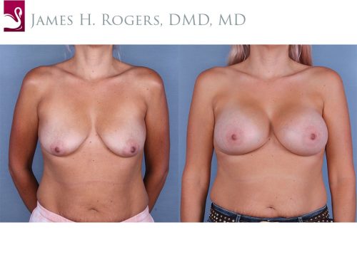 Breast Augmentation Case #65156 (Image 1)