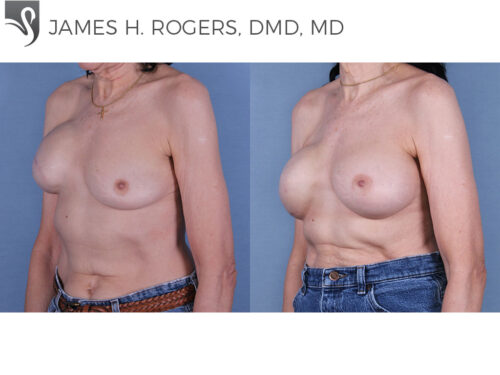 Breast Reconstruction Case #19322 (Image 2)