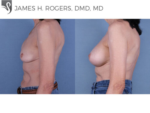 Breast Reconstruction Case #19322 (Image 3)