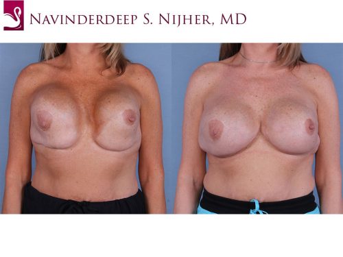 Breast Reconstruction Case #37901 (Image 1)