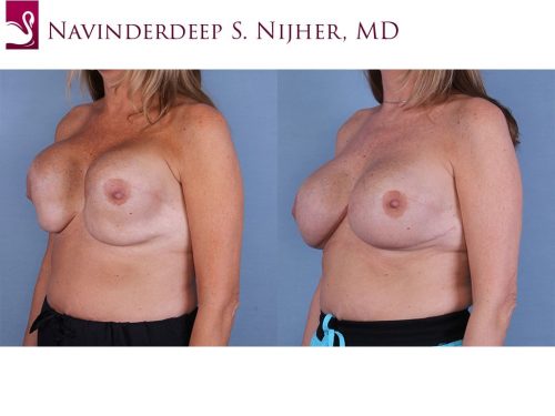 Breast Reconstruction Case #37901 (Image 2)