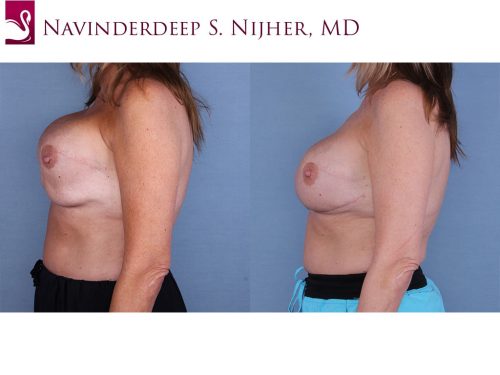 Breast Reconstruction Case #37901 (Image 3)