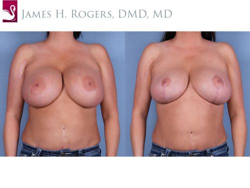 Breast Augmentation with Mastopexy (Breast Lift) Case #41525 (Image 1)