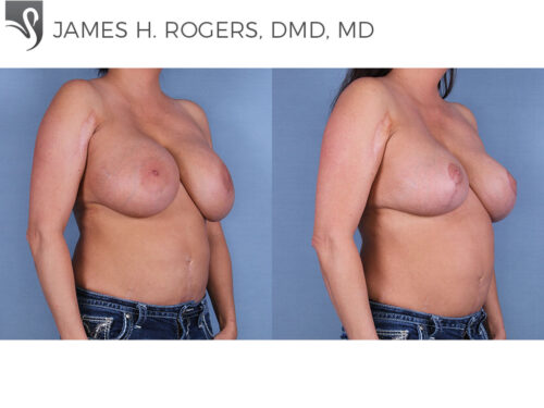 Breast Augmentation with Mastopexy (Breast Lift) Case #41525 (Image 2)