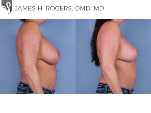 Breast Augmentation with Mastopexy (Breast Lift) Case #41525 (Image 3)