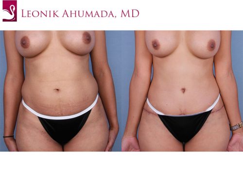 Abdominoplasty (Tummy Tuck) Case #45050 (Image 1)