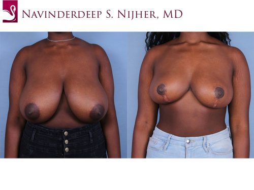 Female Breast Reduction Case #63515 (Image 1)