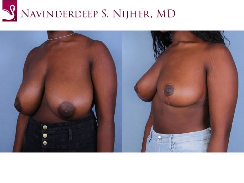 Female Breast Reduction Case #63515 (Image 2)