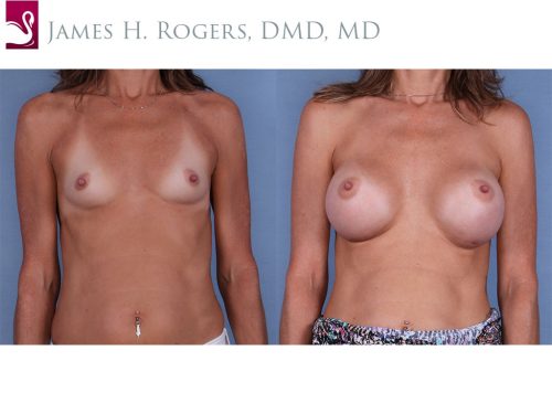 Breast Augmentation Case #63809 (Image 1)