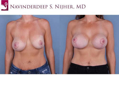 Breast Revisions Case #64103 (Image 1)