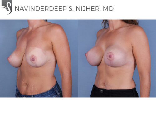 Breast Revisions Case #64103 (Image 2)