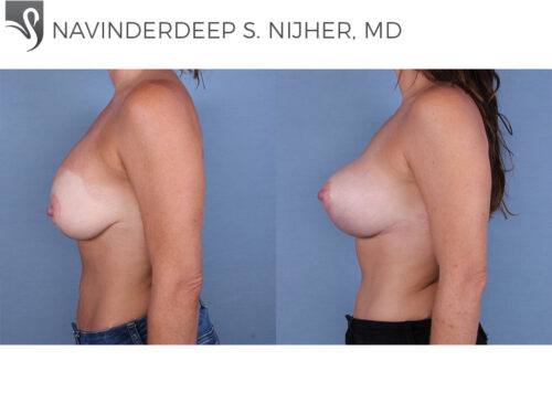 Breast Revisions Case #64103 (Image 3)