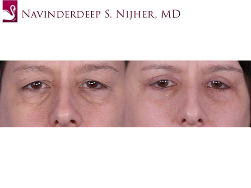 Eyelid Surgery Case #65236 (Image 1)