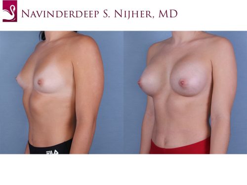 Breast Augmentation Case #65379 (Image 2)