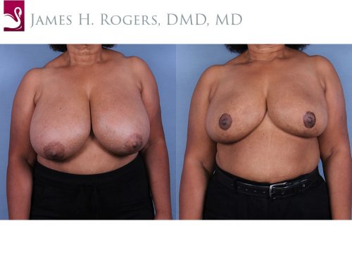 Female Breast Reduction Case #10899 (Image 1)