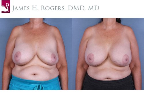 Breast Revisions Case #43399 (Image 1)