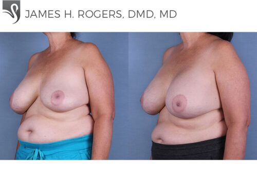 Breast Revisions Case #43399 (Image 2)