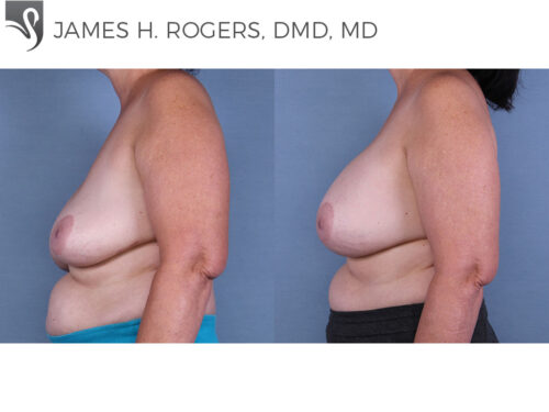 Breast Revisions Case #43399 (Image 3)